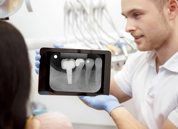 Radiografí­a Retroalveolar Periapical