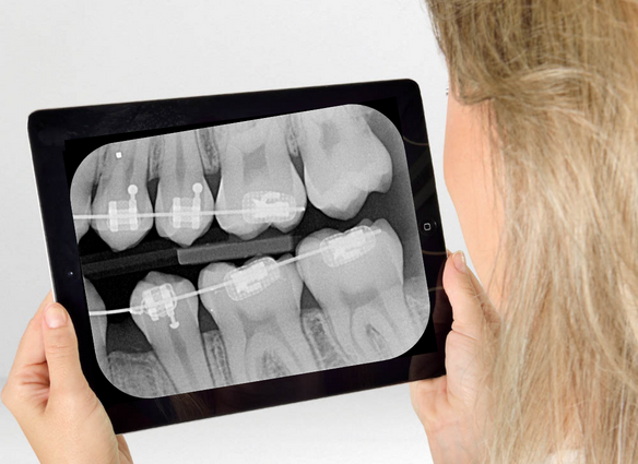 Radiografí­a Retroalveolar BiteWing